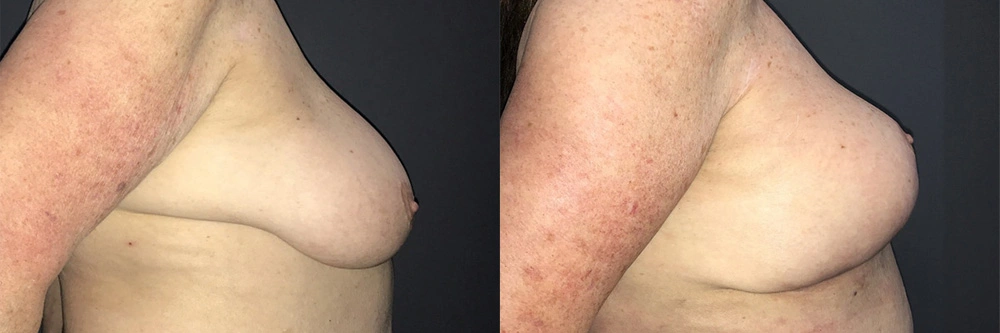 Real Patient Results in Newport Beach, CA. Preformed by Semira Bayait, MD, FACS.