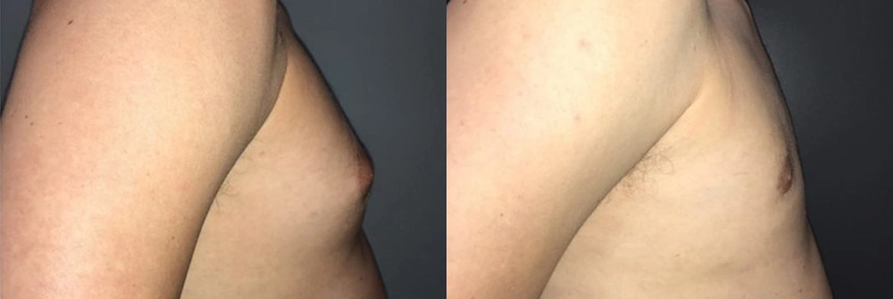 Real Patient Results in Newport Beach, CA. Preformed by Semira Bayait, MD, FACS.