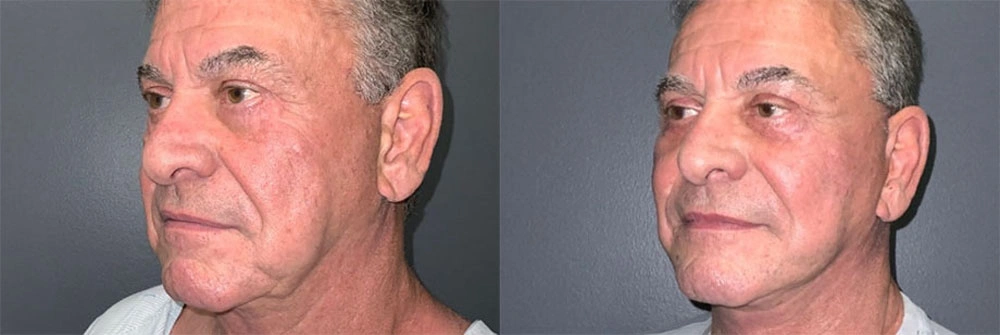 Real Patient Results in Newport Beach, CA. Preformed by Semira Bayait, MD, FACS.