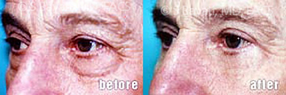Real Patient Results in Newport Beach, CA. Preformed by Semira Bayait, MD, FACS.