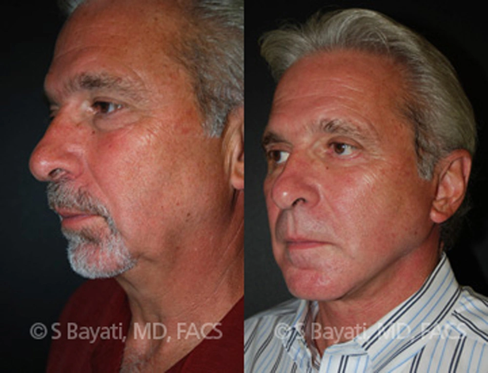 Real Patient Results in Newport Beach, CA. Preformed by Semira Bayait, MD, FACS.