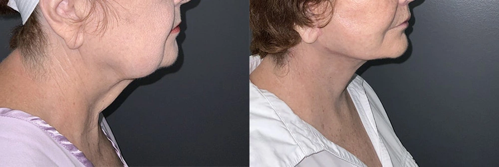 Real Patient Results in Newport Beach, CA. Preformed by Semira Bayait, MD, FACS.