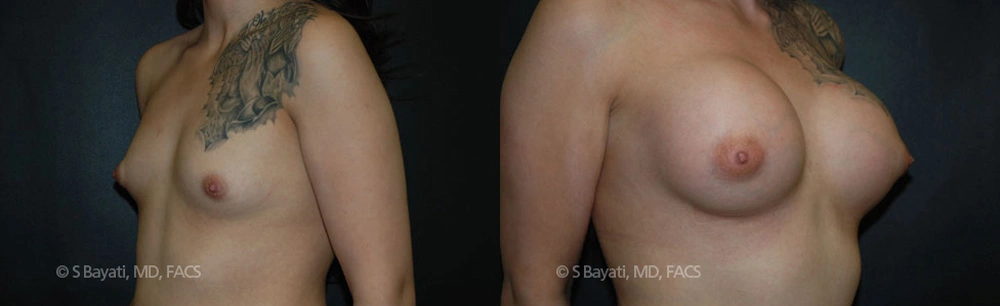 Real Patient Results in Newport Beach, CA. Preformed by Semira Bayait, MD, FACS.