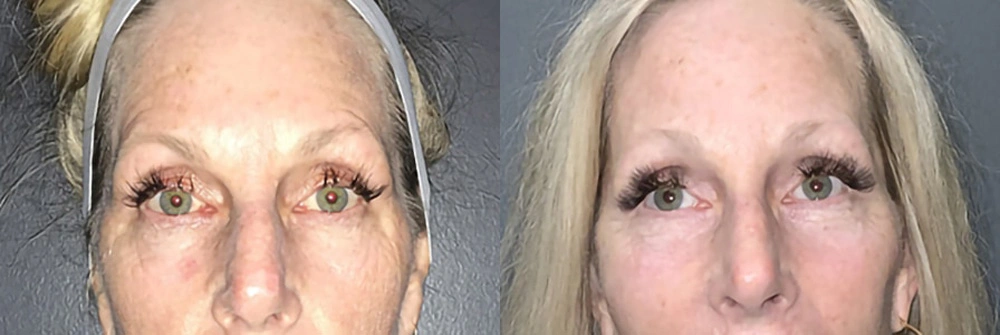 Real Patient Results in Newport Beach, CA. Preformed by Semira Bayait, MD, FACS.