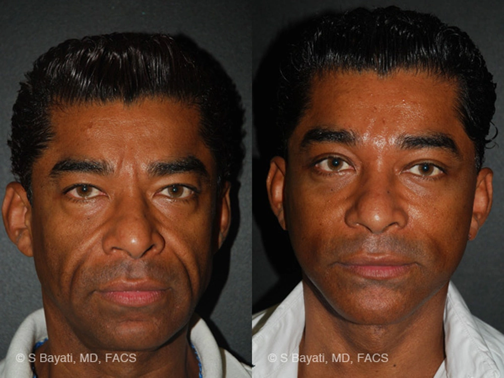 Real Patient Results in Newport Beach, CA. Preformed by Semira Bayait, MD, FACS.