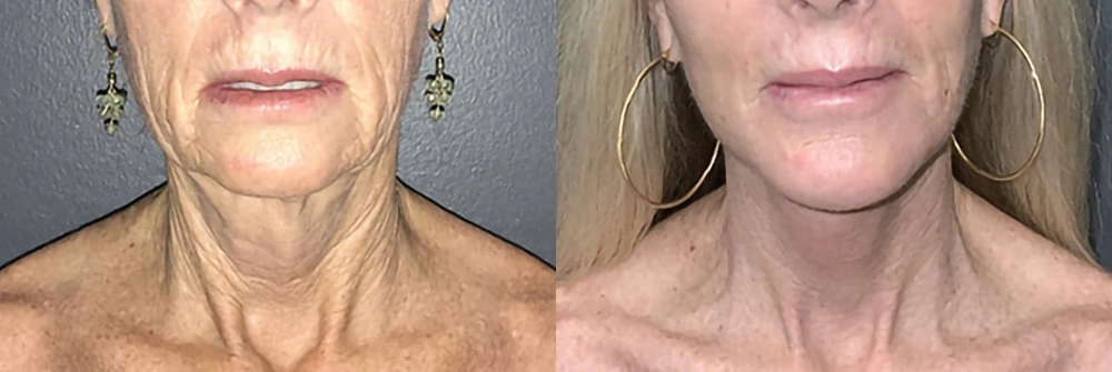 Real Patient Results in Newport Beach, CA. Preformed by Semira Bayait, MD, FACS.