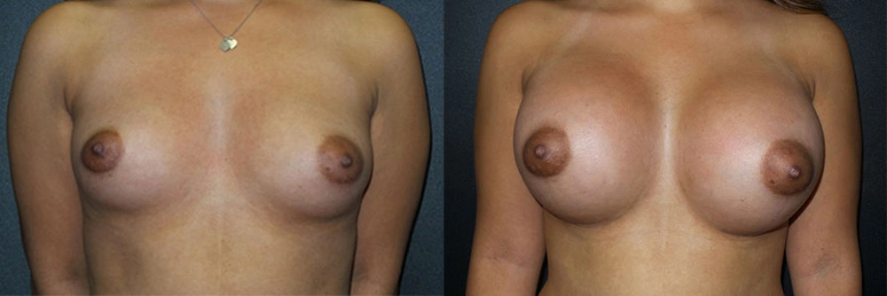 Real Patient Results in Newport Beach, CA. Preformed by Semira Bayait, MD, FACS.