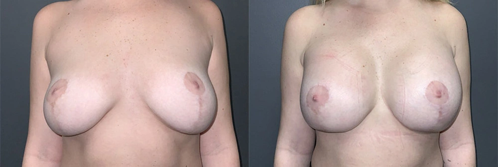 Real Patient Results in Newport Beach, CA. Preformed by Semira Bayait, MD, FACS.