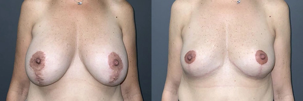 Real Patient Results in Newport Beach, CA. Preformed by Semira Bayait, MD, FACS.