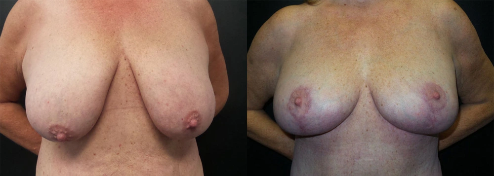 Real Patient Results in Newport Beach, CA. Preformed by Semira Bayait, MD, FACS.