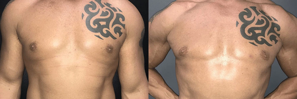 Real Patient Results in Newport Beach, CA. Preformed by Semira Bayait, MD, FACS.