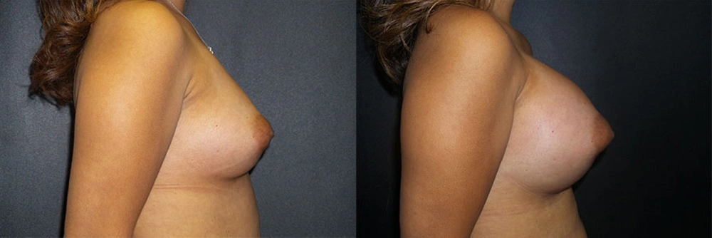 Real Patient Results in Newport Beach, CA. Preformed by Semira Bayait, MD, FACS.