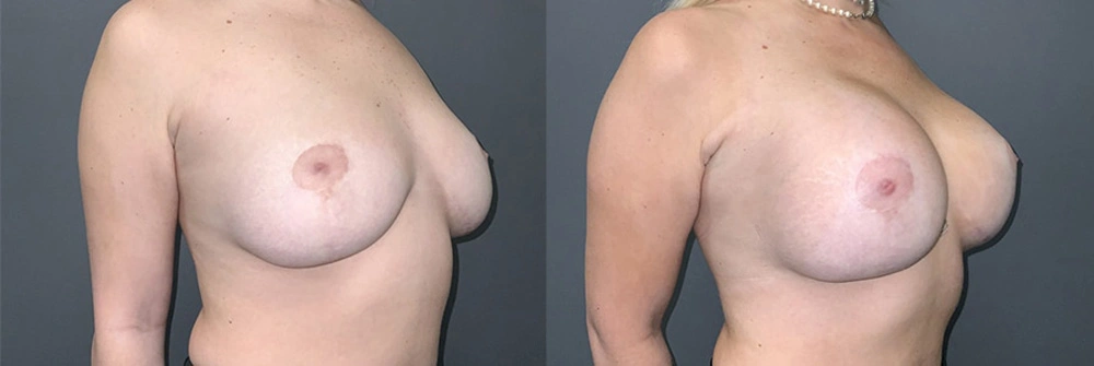 Real Patient Results in Newport Beach, CA. Preformed by Semira Bayait, MD, FACS.