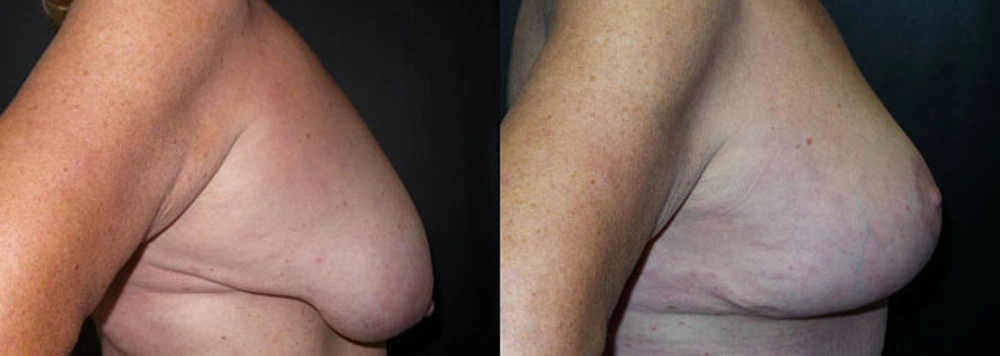 Real Patient Results in Newport Beach, CA. Preformed by Semira Bayait, MD, FACS.