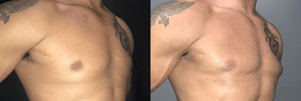 Real Patient Results in Newport Beach, CA. Preformed by Semira Bayait, MD, FACS.