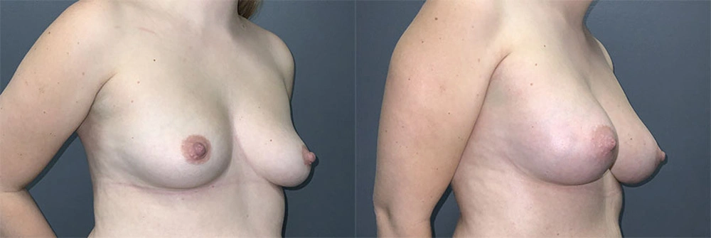 Real Patient Results in Newport Beach, CA. Preformed by Semira Bayait, MD, FACS.