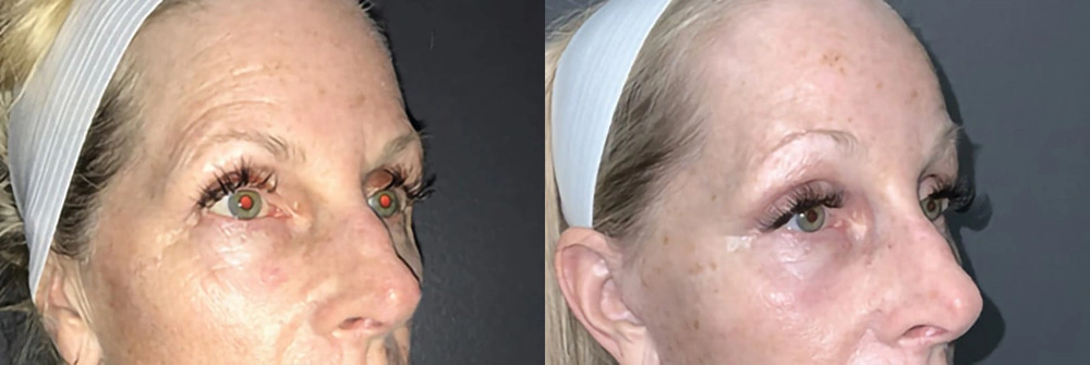 Real Patient Results in Newport Beach, CA. Preformed by Semira Bayait, MD, FACS.