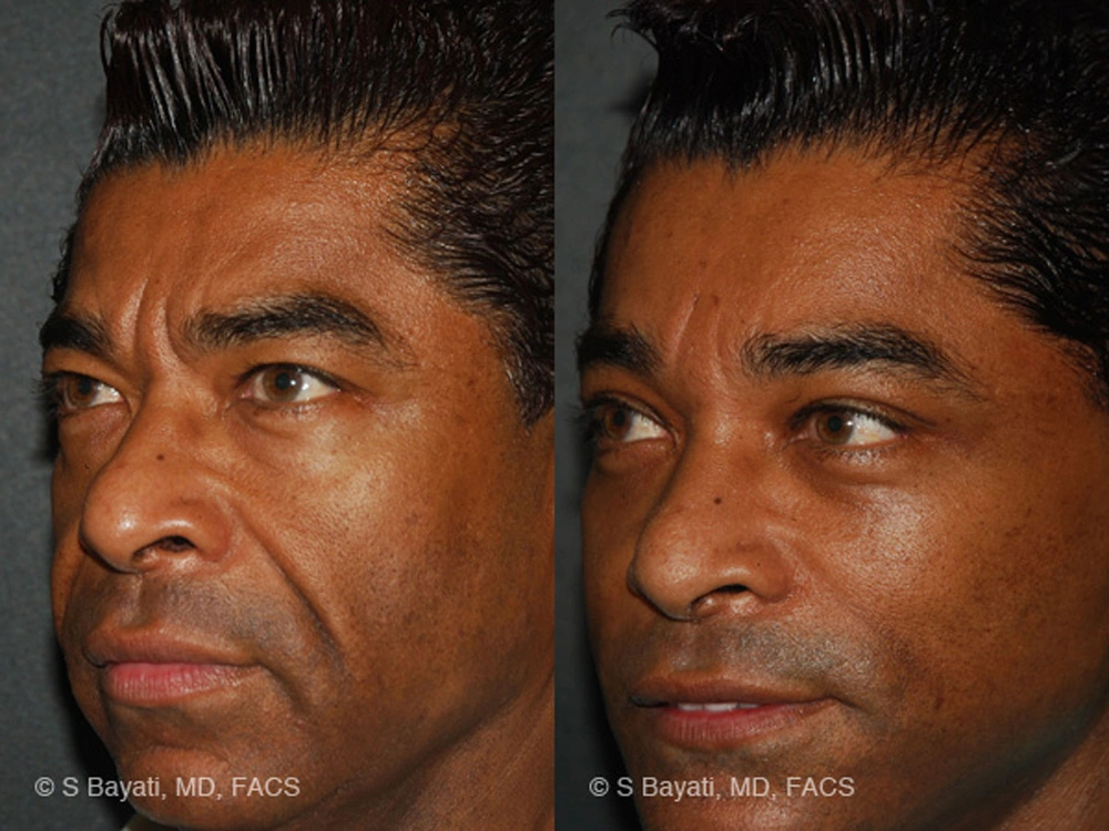 Real Patient Results in Newport Beach, CA. Preformed by Semira Bayait, MD, FACS.
