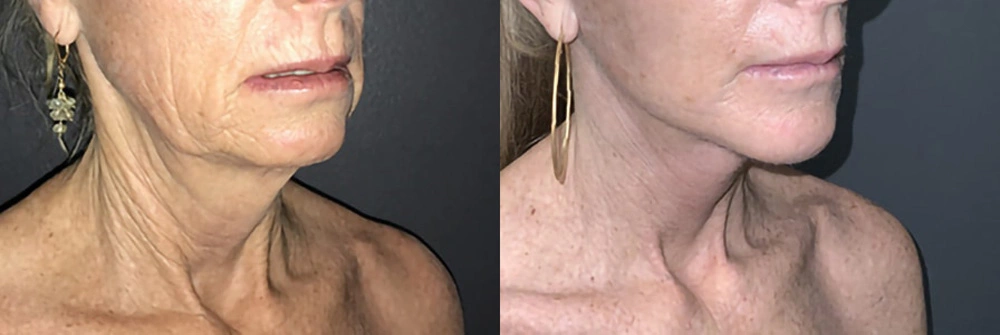 Real Patient Results in Newport Beach, CA. Preformed by Semira Bayait, MD, FACS.