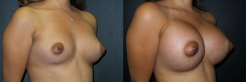 Real Patient Results in Newport Beach, CA. Preformed by Semira Bayait, MD, FACS.
