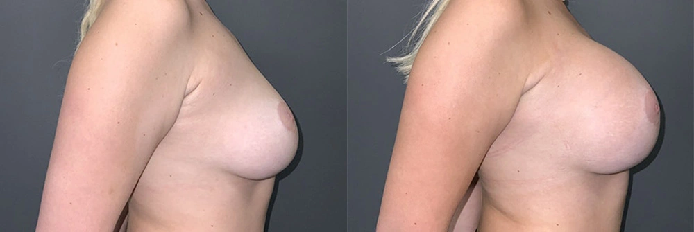 Real Patient Results in Newport Beach, CA. Preformed by Semira Bayait, MD, FACS.
