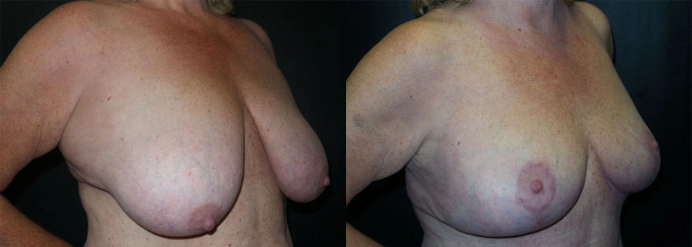 Real Patient Results in Newport Beach, CA. Preformed by Semira Bayait, MD, FACS.