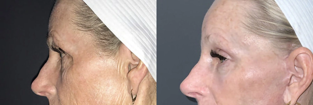 Real Patient Results in Newport Beach, CA. Preformed by Semira Bayait, MD, FACS.