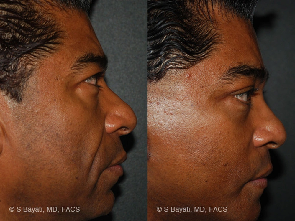 Real Patient Results in Newport Beach, CA. Preformed by Semira Bayait, MD, FACS.
