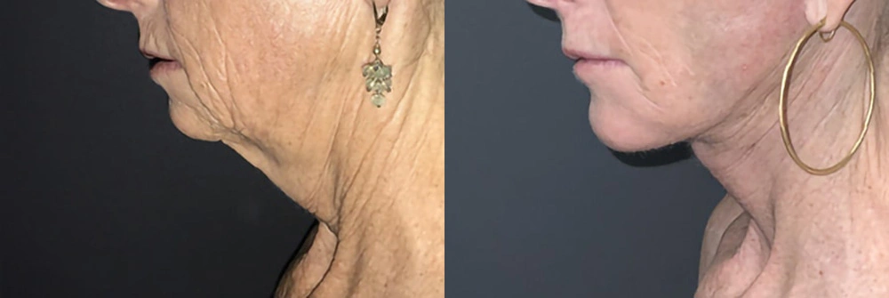 Real Patient Results in Newport Beach, CA. Preformed by Semira Bayait, MD, FACS.