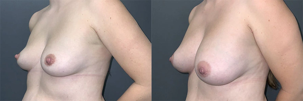 Real Patient Results in Newport Beach, CA. Preformed by Semira Bayait, MD, FACS.