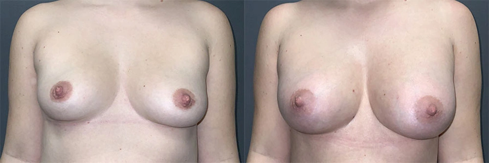 Real Patient Results in Newport Beach, CA. Preformed by Semira Bayait, MD, FACS.