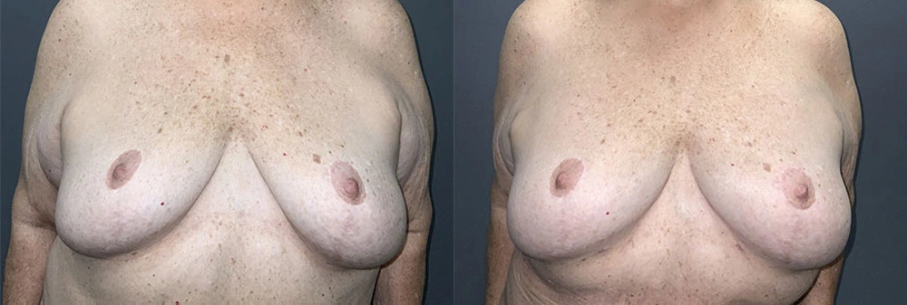 Real Patient Results in Newport Beach, CA. Preformed by Semira Bayait, MD, FACS.