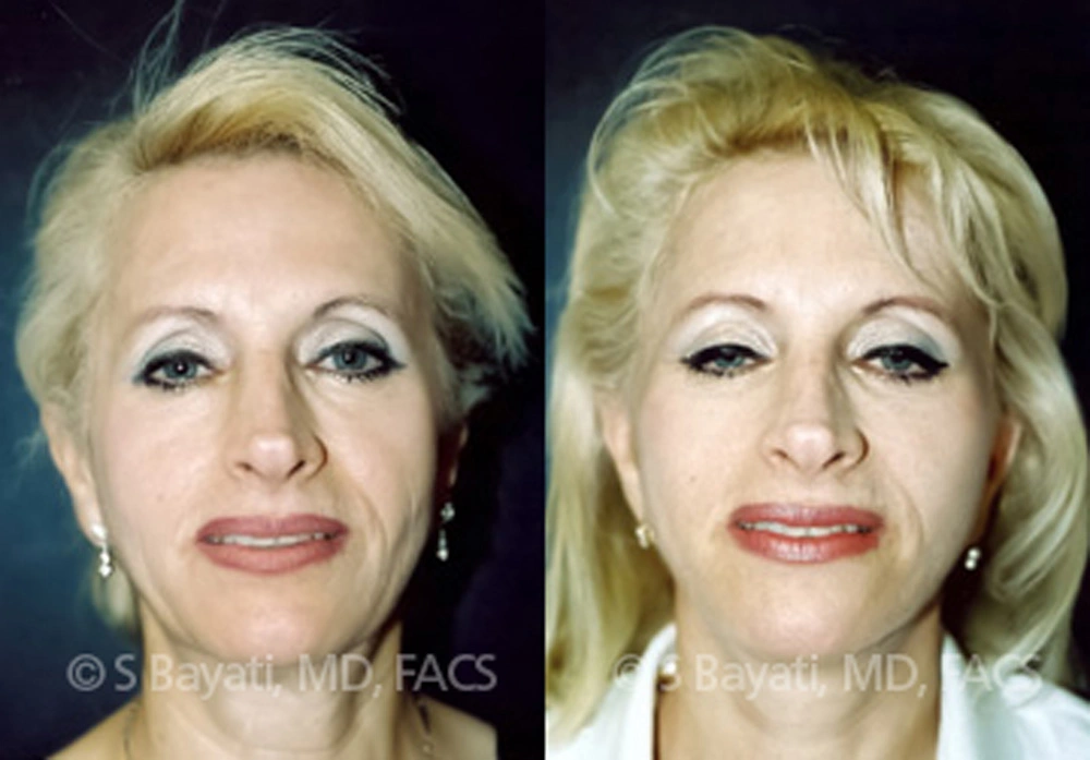 Real Patient Results in Newport Beach, CA. Preformed by Semira Bayait, MD, FACS.