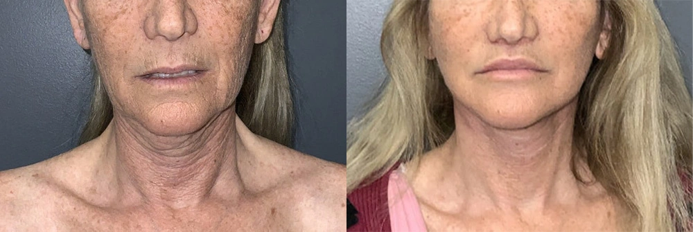 Real Patient Results in Newport Beach, CA. Preformed by Semira Bayait, MD, FACS.