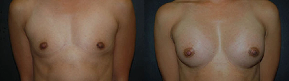 Real Patient Results in Newport Beach, CA. Preformed by Semira Bayait, MD, FACS.