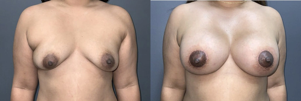 Real Patient Results in Newport Beach, CA. Preformed by Semira Bayait, MD, FACS.