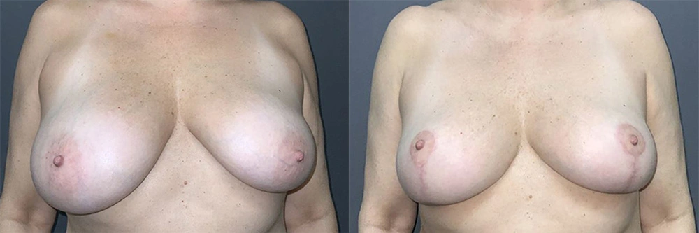 Real Patient Results in Newport Beach, CA. Preformed by Semira Bayait, MD, FACS.
