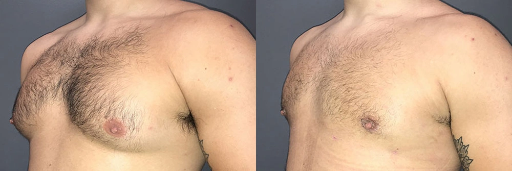 Real Patient Results in Newport Beach, CA. Preformed by Semira Bayait, MD, FACS.