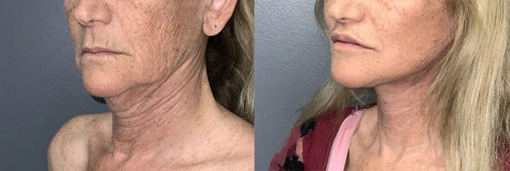 Real Patient Results in Newport Beach, CA. Preformed by Semira Bayait, MD, FACS.