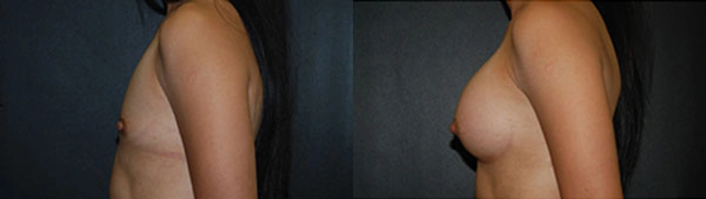 Real Patient Results in Newport Beach, CA. Preformed by Semira Bayait, MD, FACS.