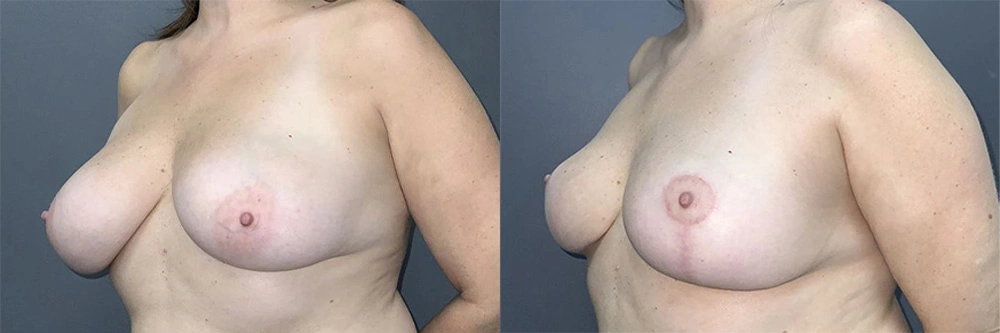 Real Patient Results in Newport Beach, CA. Preformed by Semira Bayait, MD, FACS.