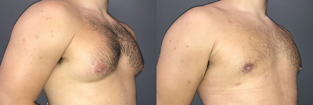 Real Patient Results in Newport Beach, CA. Preformed by Semira Bayait, MD, FACS.