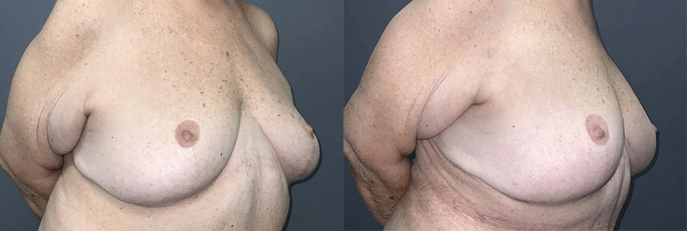 Real Patient Results in Newport Beach, CA. Preformed by Semira Bayait, MD, FACS.