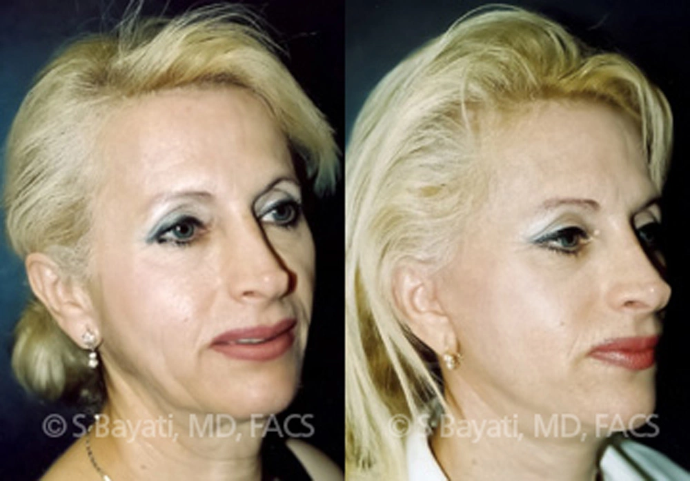 Real Patient Results in Newport Beach, CA. Preformed by Semira Bayait, MD, FACS.