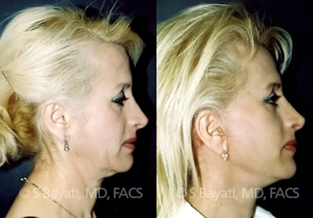 Real Patient Results in Newport Beach, CA. Preformed by Semira Bayait, MD, FACS.