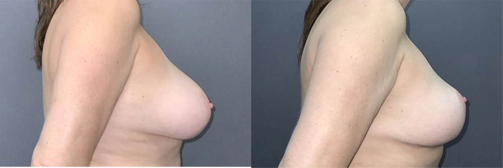 Real Patient Results in Newport Beach, CA. Preformed by Semira Bayait, MD, FACS.
