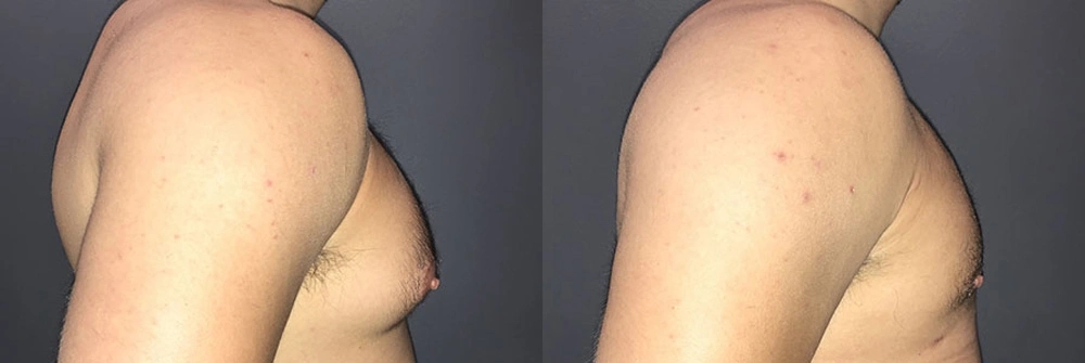 Real Patient Results in Newport Beach, CA. Preformed by Semira Bayait, MD, FACS.
