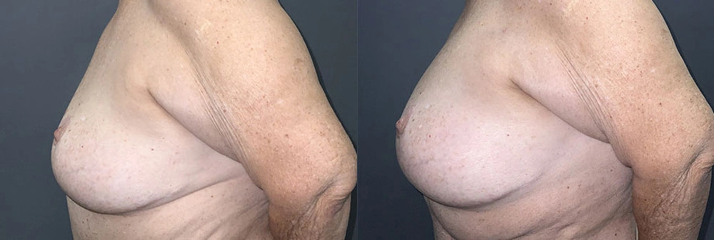Real Patient Results in Newport Beach, CA. Preformed by Semira Bayait, MD, FACS.