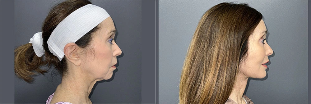 Real Patient Results in Newport Beach, CA. Preformed by Semira Bayait, MD, FACS.