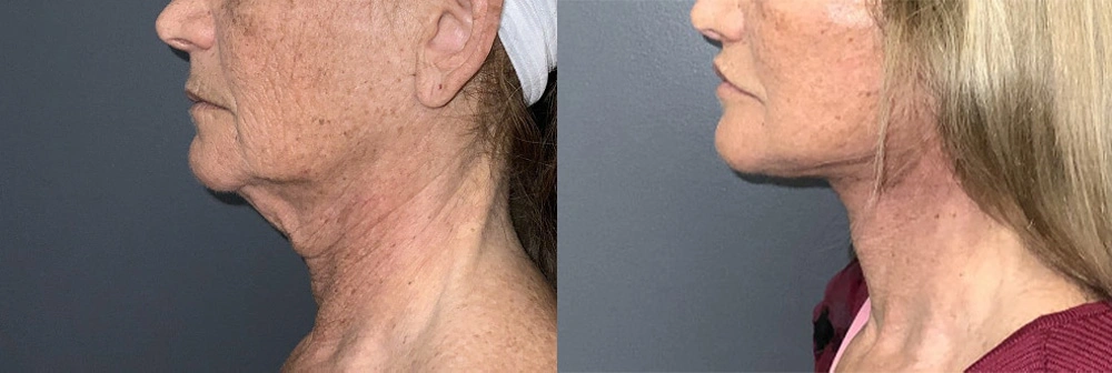 Real Patient Results in Newport Beach, CA. Preformed by Semira Bayait, MD, FACS.